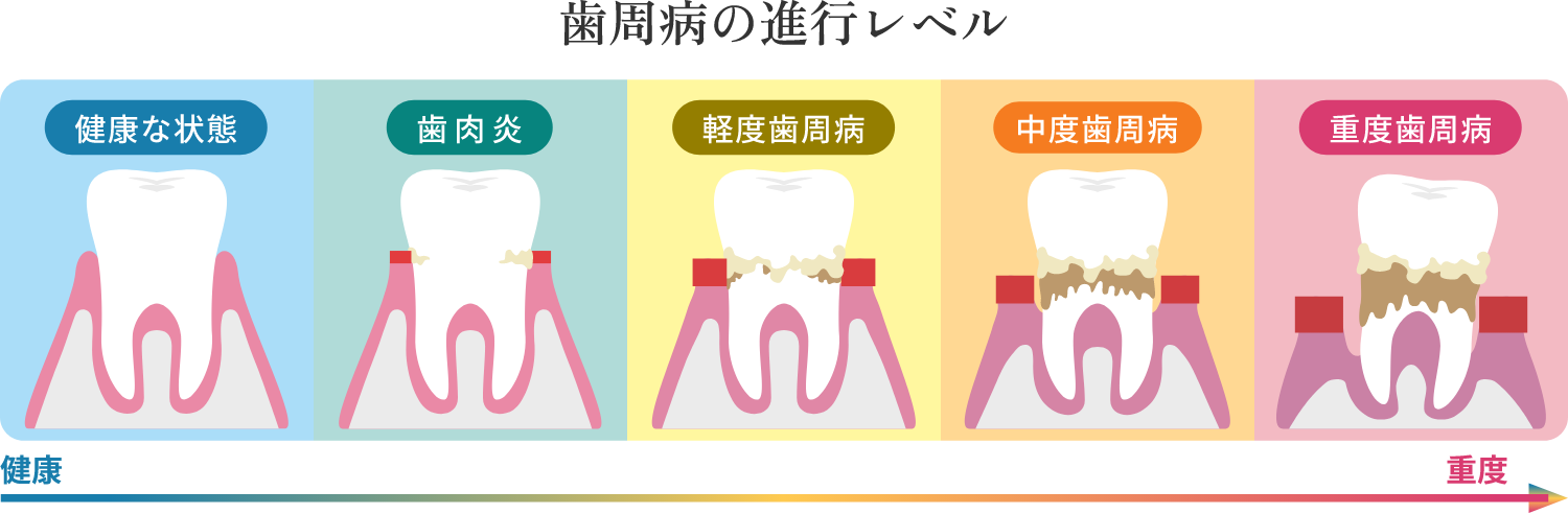 歯周病の進行レベル