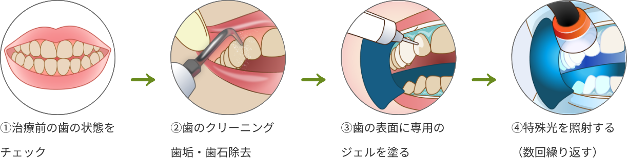 オフィスホワイトニング