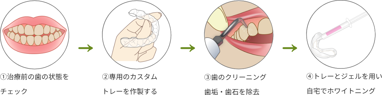 ホームホワイトニング